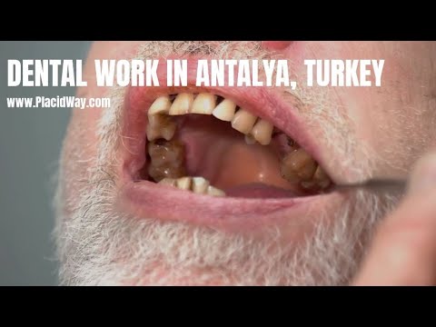 Watch Video on Dental Work in Antalya, Turkey