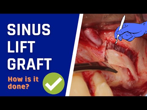 SINUS LIFT surgery with bone graft
