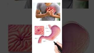 Download lagu Omee Capsule Uses And Sideeffects | Best Tablet For Acidity Reflux |@DrxMdAsif mp3