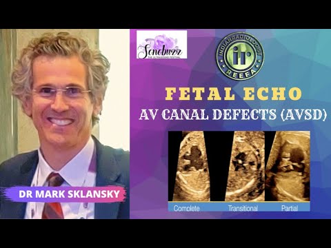 ATRIO VENTRICULAR CANAL DEFECTS | MARK SKLANSKY | AVSD | FETAL ECHO | FETAL CARDIAC ANOMALY | DOWN'S