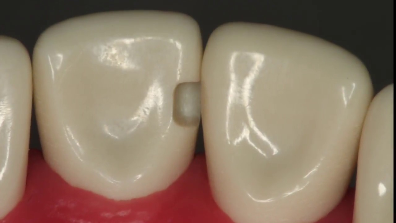 CLASS III Preparation for Composite #8 ML