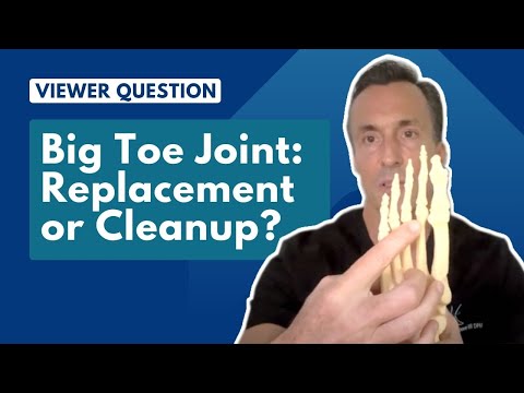 Big Toe Joint Replacement vs. Joint Cleanup | Ask Dr. Moore