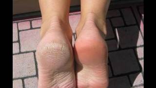 How I cure my dry feet