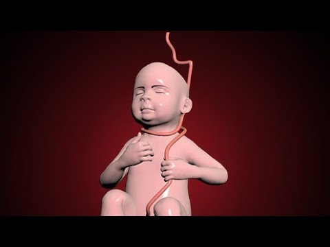 Nuchal cord - umbilical cord becomes wrapped around the fetal neck 360 degrees. #education