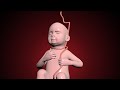 Nuchal Cord Umbilical Cord Becomes Wrapped Around The Fetal Neck 360 Degrees Education