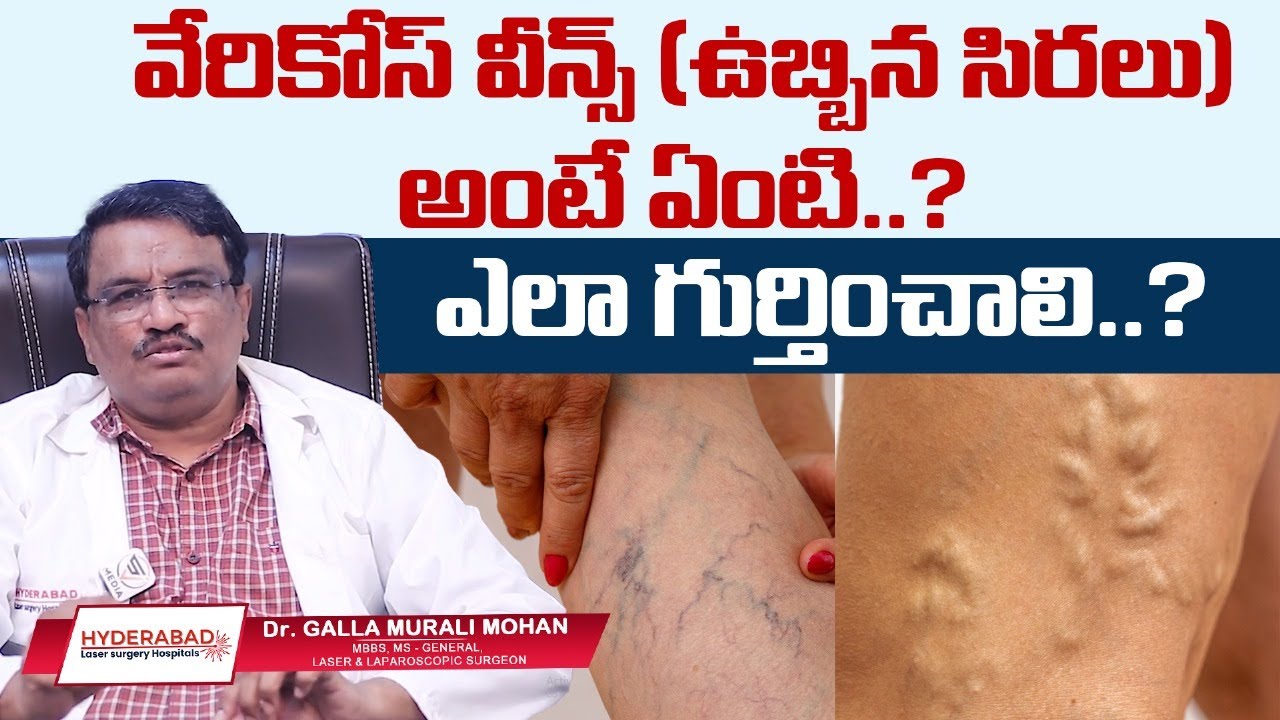 Varicose Veins Video 7