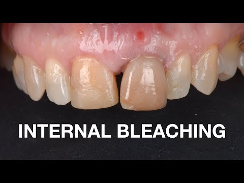 Internal Bleaching Protocol