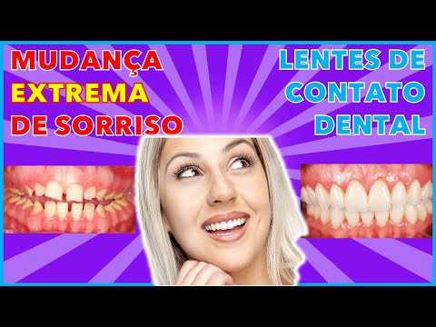download lagu mp3 mp4 Dentista Estetica Curitiba, download lagu Dentista Estetica Curitiba gratis, unduh video klip Dentista Estetica Curitiba