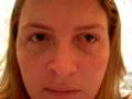 Fun With Bell S Palsy Nose Twitches