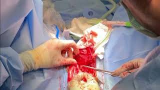 Core Videos (2025): Penile Cancer: Total Penectomy with Perineal Urethrostomy