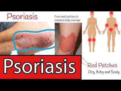 Psoriasis Symptoms and Treatment. Everything you need to know about Psoriasis