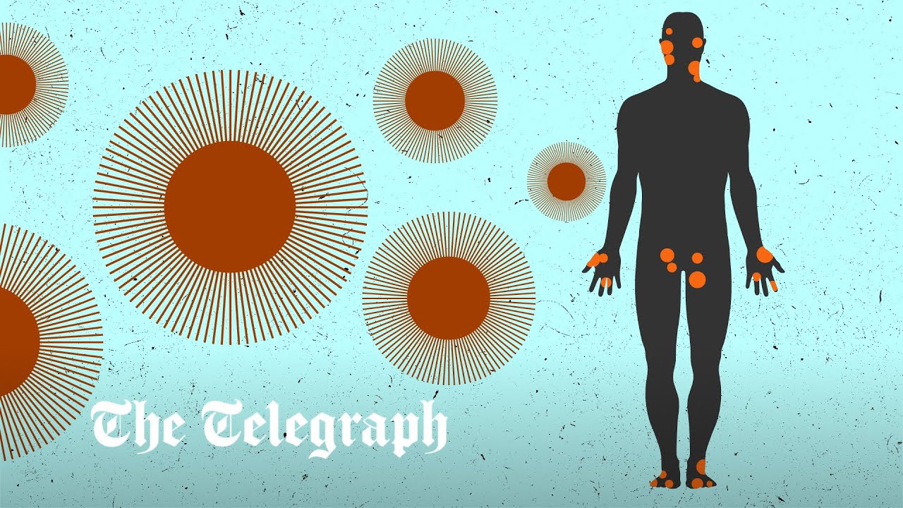 Sadiq Khan appelle à une action urgente pour lutter contre l’augmentation des cas de monkeypox