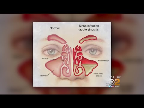 Doctor: Tried And True Methods For Sinus Relief Are Still Best