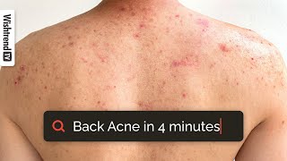 How To Get Rid Of Back Acne | What Habits Cause Bacne? Tips & Products ✨
