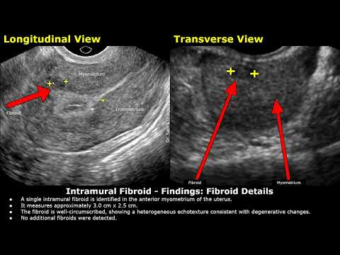 Intramural Fibroid Ultrasound Report Example | Uterine Leiyomyomas | Uterus Sonography | Radiology