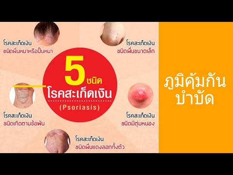 AAIvanov ครีมสำหรับการรักษาโรคสะเก็ดเงิน โรคสะเก็ดเงินเป็นโรคทางด้านจิตใจ