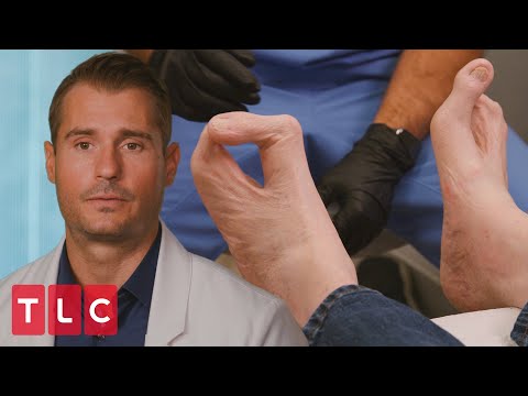 image-What is clawed foot?
