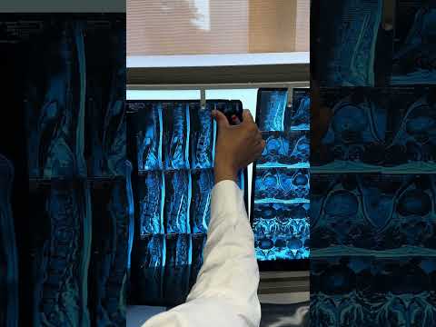 MRI of healed Spinal TB infection : cured completely without surgery #tuberculosisspine #pune #india