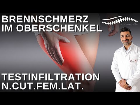Burning pain in the thigh - Meralgia paresthetica | Test infiltration of the lateral femoral cuta...
