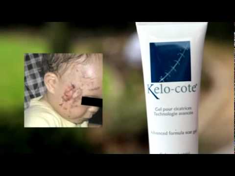 comment appliquer kelo cote