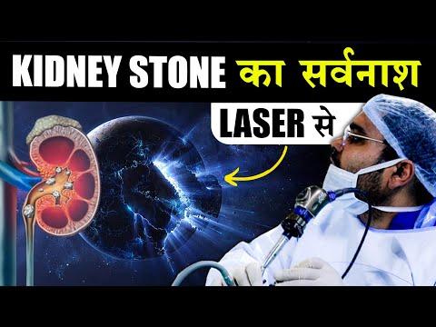 Kidney Stone Laser Surgery : VLOG