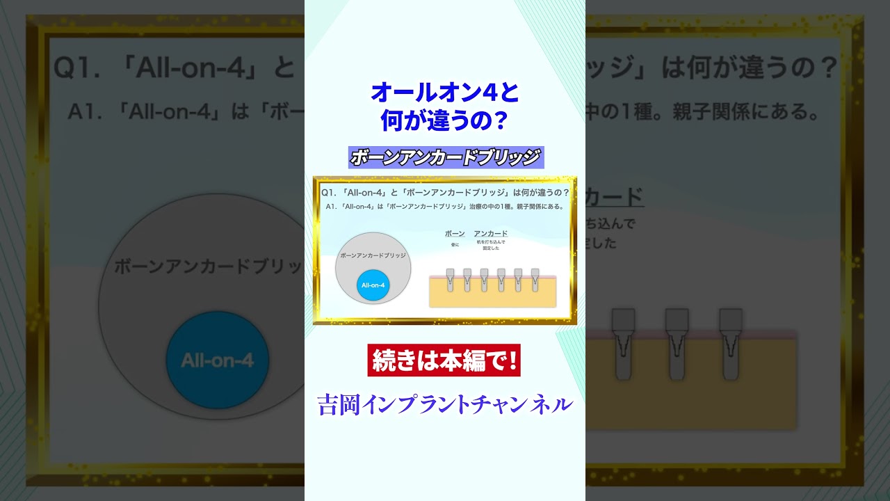 オールオン４と何が違うの？#shorts#インプラント#ボーンアンカードブリッジ