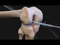 Arthrex ACL Reconstruction