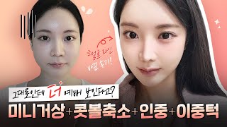 미니거상만 했는데 동안 얼굴 완성 l 4종세트 성형 브이로그 (콧볼+리프팅+인중+턱)