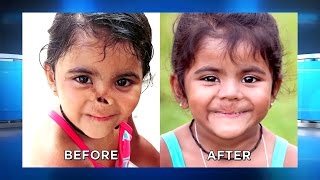 Sisters Incredible Makeover: Roopa’s Nose