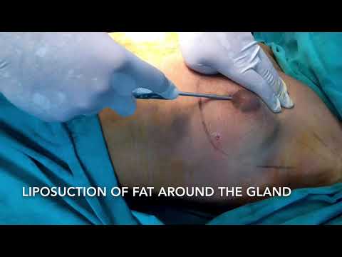 Patient Recovery Case — Video 40 (Liposuction)
