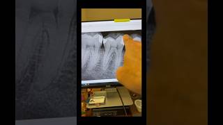 RCT of tooth 30. #dentists #dentalprosthesis #rootcanaltherapy @FlexivoDental #dentalcare