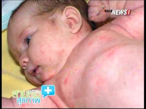 โรคสะเก็ดเงินพุพอง herpetiformis รักษาหนังศีรษะแห้งผิวหนังอักเสบ seborrheic