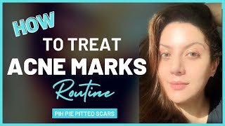 How to Treat Acne Marks on Face I Post Inflammatory Hyperpigmentation Treatment I Pitted scars