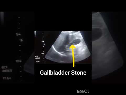 Ultrasound abdomen showing Gallbladder Stone! Cholelithiasis!#ultrasoundmadeeasy86#viralvideo#uk#usa