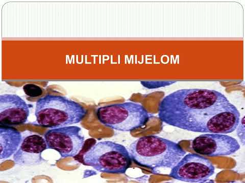 7  Hronična limfocitna leukemija i multipli mijelom Prof dr Jelena Bila   NEOPLAZIJE ZRELIH B LIMFOC
