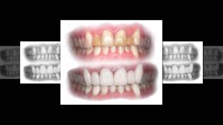 preview picture of video 'Teeth Whitening Cave Creek Zoom Teeth Whitening Dentist'