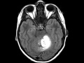 Pilocytic Astrocytoma