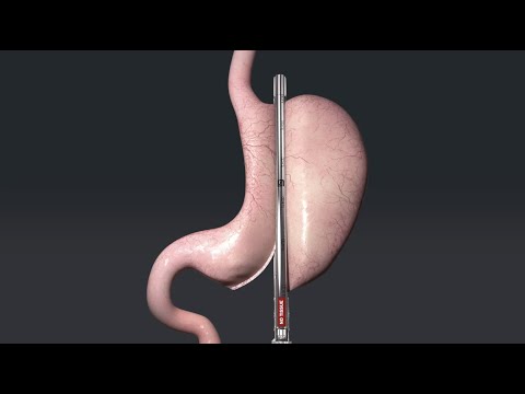 Animation of Sleeve Gastrectomy with Titan SGS™