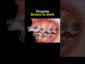 Amazing Braces Can Fix All Problem Teeth Braces Orthodontist Dentist