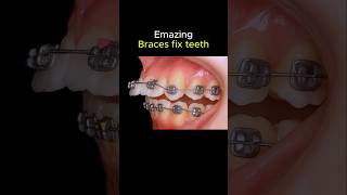 Download lagu Amazing braces. can fix all problem teeth #braces #orthodontist #dentist mp3