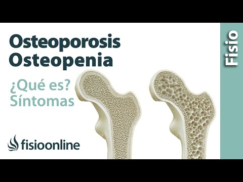 Osteoporosis y Osteopenia: Qué es, Causas, Síntomas y Tratamiento