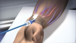 New Route to the Heart - Mayo Clinic