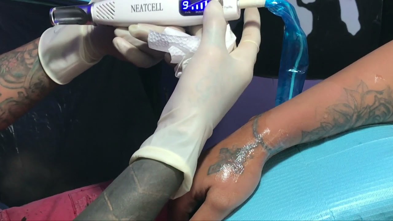 Stylo laser anti taches pro