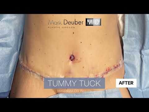 Tummy tuck immediate before & after results