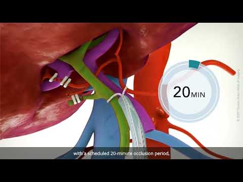 Laparoscopic right hepatectomy