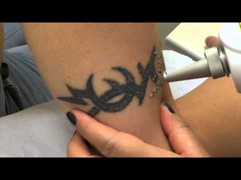 Tattoo Removal and Results at Laserexpress in Dublin