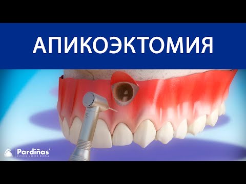 Апикоэктомия – Apicoectomy ©