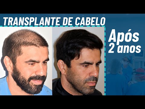 Miniatura do depoimento: Minha Opinião Honesta do Transplante Capilar