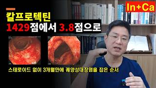<Entity {'ja': 'カルプロテクチン1429から38へ - ステロイドなしで3ヶ月で潰瘍性大腸炎を抑えた順序。', 'ko': '칼프로텍틴 1429점에서 3 8점으로 -  스테로이드 없이 3개월 만에 궤양성대장염을 잡은 순서.', 'en': 'From 1429 to 38 in Calprotectin - The sequence of managing ulcerative colitis in 3 months without steroids.'}>