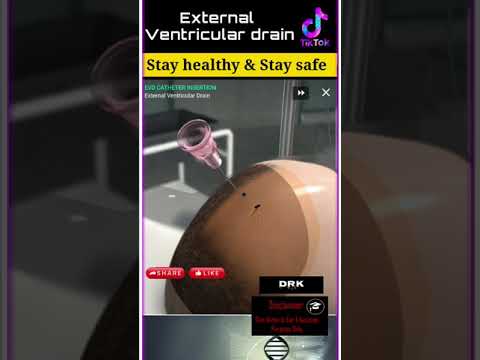 External ventricular drain